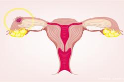 女性患有多囊卵巢可以做试管吗?三代试管的成功率高吗?